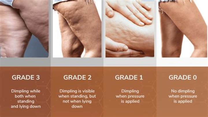 Cellulite: Do Guys Notice It?